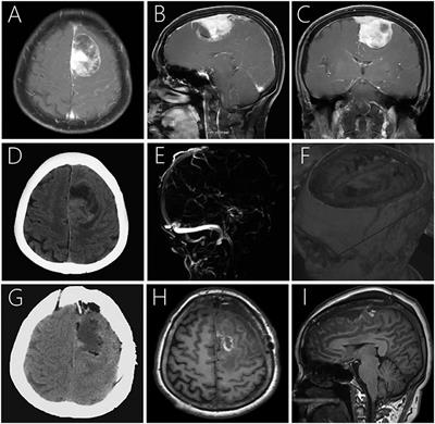 Primary Intracranial Ewing Sarcoma/Peripheral Primitive Neuroectodermal Tumor Mimicking Meningioma: A Case Report and Literature Review